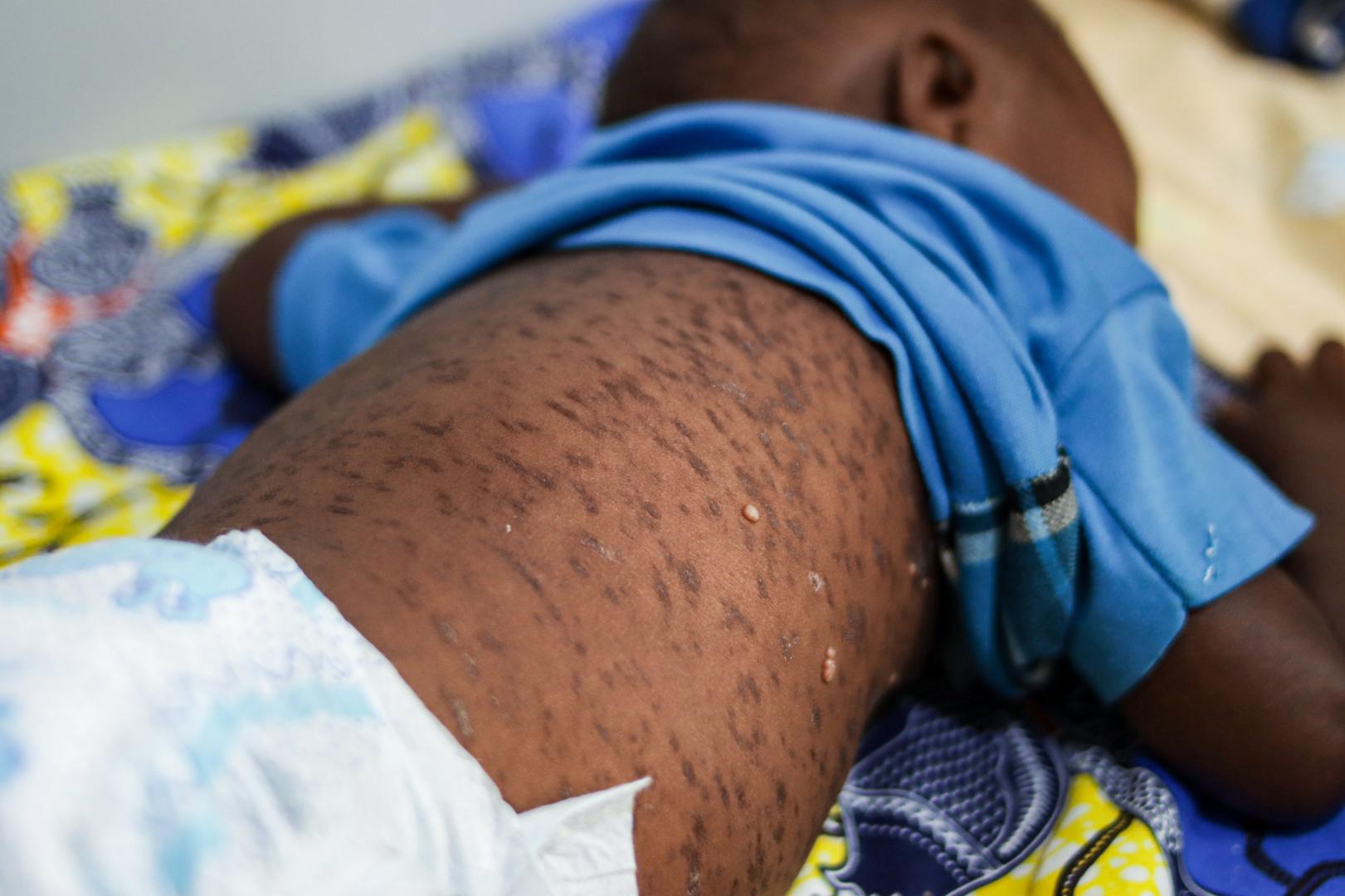Measles outbreak threatens public health in Cuanza Sul