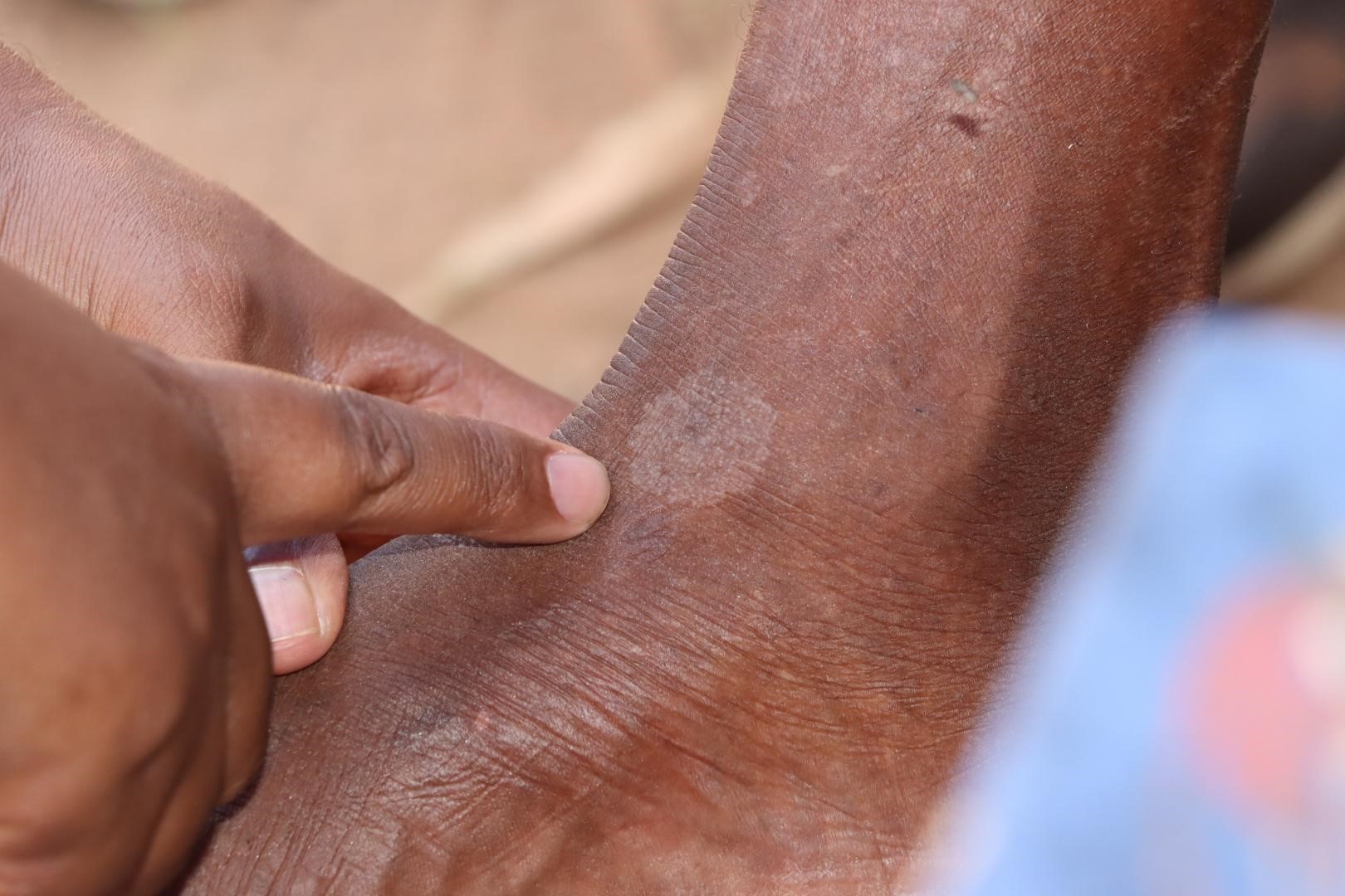 Early detection a game-changer in the fight against leprosy in Madagascar