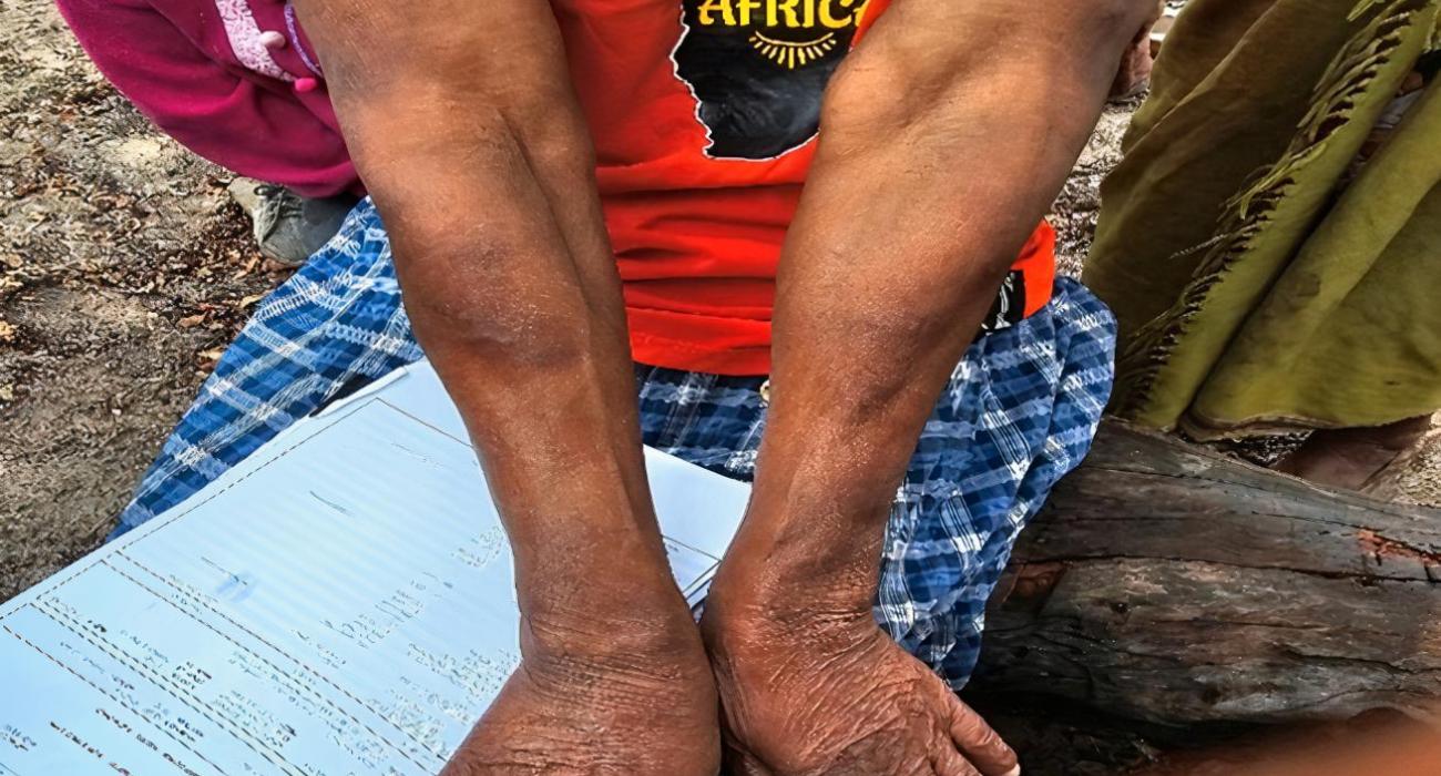 Leprosy patient treated with TB medications experiencing mild type 2 reaction