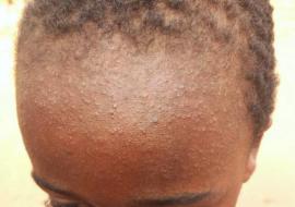 A little boy suffering from Measles A little boy suffering from Measles