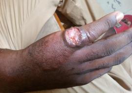 A patient diagnosed with Cutaneous Leishmaniasis.jpg
