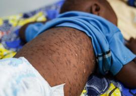 Measles outbreak threatens public health in Cuanza Sul