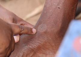 Early detection a game-changer in the fight against leprosy in Madagascar