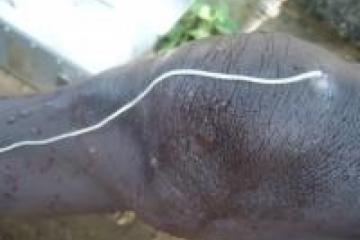 Guinea worm emerging from the patient's knee.