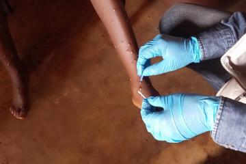 Zimbabwe Reports First Cases of Mpox thumbnail