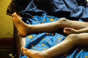 Un jeune enfant soigné du virus Mpox dans le centre de traitement de Lwiro, dans la zone de santé de Miti-Murhesa, au Sud-Kivu. WHO/Eugene Kabambi