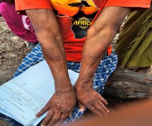 Leprosy patient treated with TB medications experiencing mild type 2 reaction