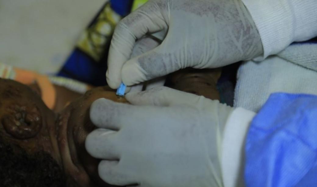 Améliorer le diagnostic de la mpox au cœur de l’épidémie en RDC 