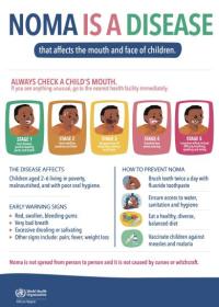 Poster for raising awareness and promoting early detection of noma